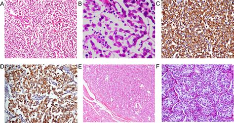Complete Androgen Insensitivity Syndrome With Concomitant Seminoma And Sertoli Cell Adenoma An