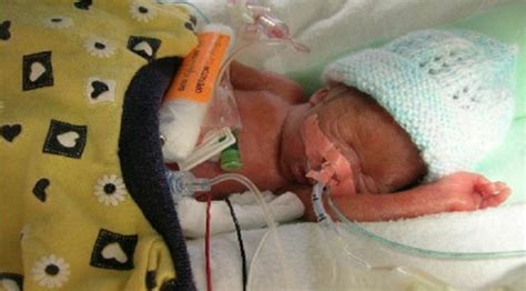 Born At 22 Weeks Premature Twins Celebrate Ninth Birthday