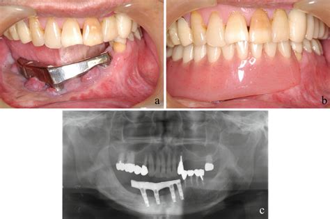 Oral And Dental Healthcare For Oral Cancer Patients Planning