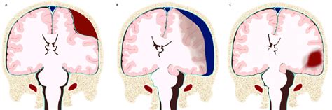 Different Types Of Post Traumatic Intracranial Haematoma A Epidural