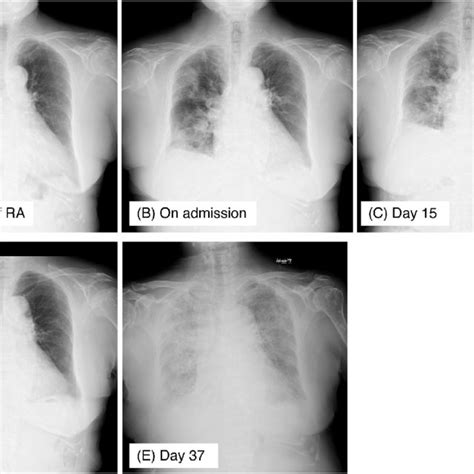 Bronchoscopic Findings Showing Diffuse Alveolar Hemorrhage A