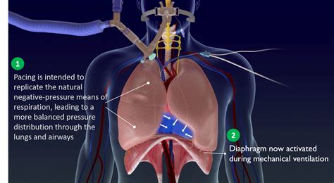 Uf Health Among First In World To Use Novel Diaphragmatic Pacer To Help