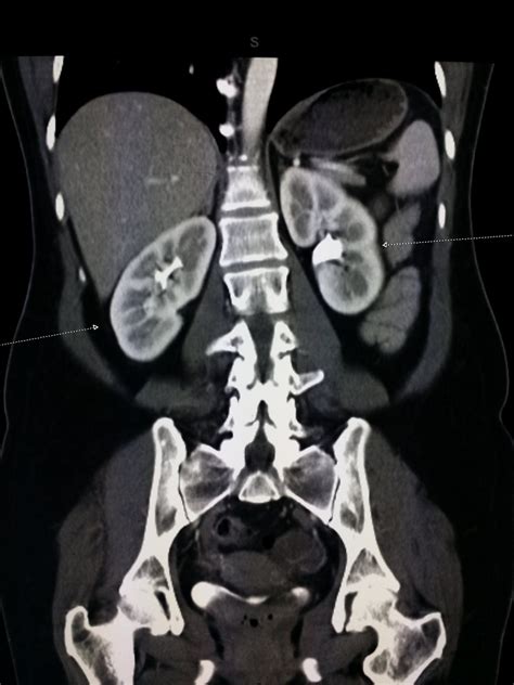 Kidney Mri