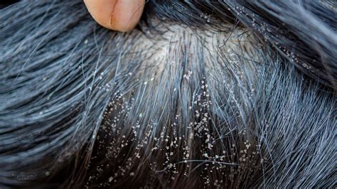 Top More Than 138 Bad Lice In Hair Best Vn