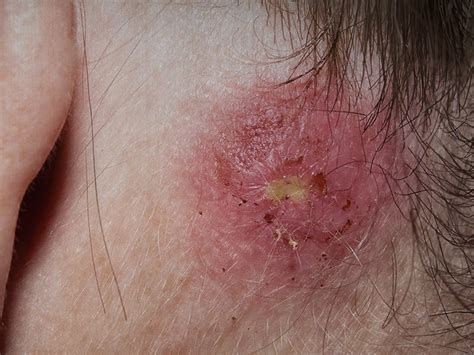 Staph Infection Types Symptoms Causes Treatments