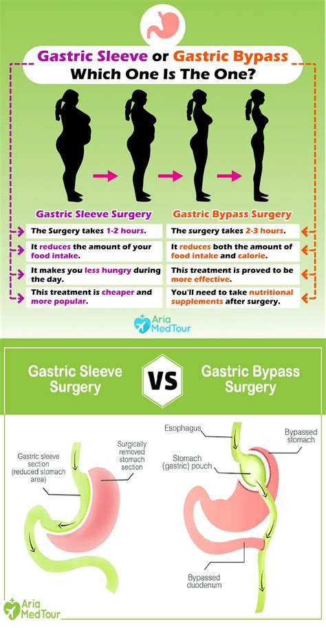 Gastric Sleeve Lashell Poland