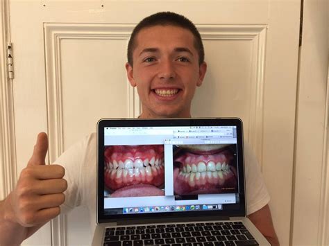 Braces Before And After Dental Braces Invisalign