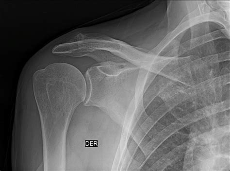 Calcific Tendinitis Of Supraspinatus Tendon Image Radiopaedia Org