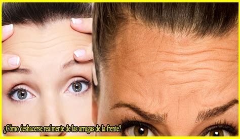 Dermatólogos Así Se Tratan Las Arrugas De La Frente Y Retrasan Su