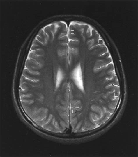 Early Detection Of Global Cerebral Anoxia Improved Accuracy By High B