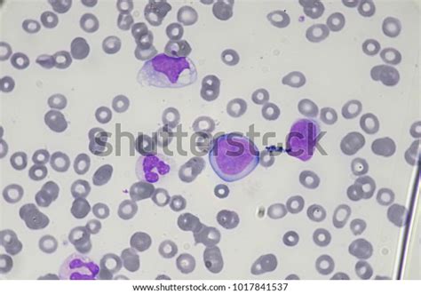 Leukemia Cell Blast Cell Acute Leukemia Stock Photo Edit Now 1017841537