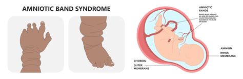 What Is Amniotic Band Syndrome
