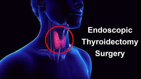 Thyroidectomy Thyroid Gland Thyroid Cancer Thyroid Surgery