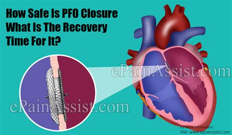 How Safe Is Pfo Closure And What Is The Recovery Time For It And Can Pfo