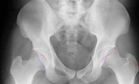 Hip Labral Tears And Femoroacetabular Impingement A Common Cause Of