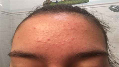 How To Get Rid Of Cystic Acne On Forehead Youtube