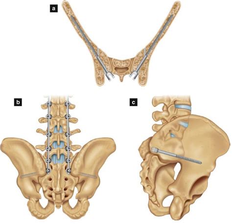 Distal Fixation For Adult Lumbar Scoliosis Indications And Techniques