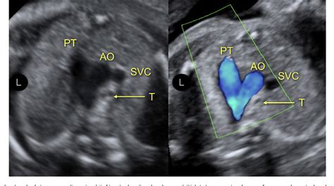 Normal Fetal Heart Ultrasound Artofit