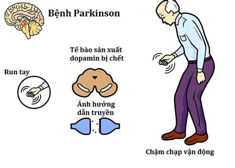 Những điều Cần Biết Về Bệnh Parkinson ở Người Cao Tuổi