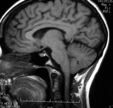Mri Brain Tumor Pituitary