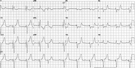 Sgarbossa Criteria LITFL ECG Library Diagnosis