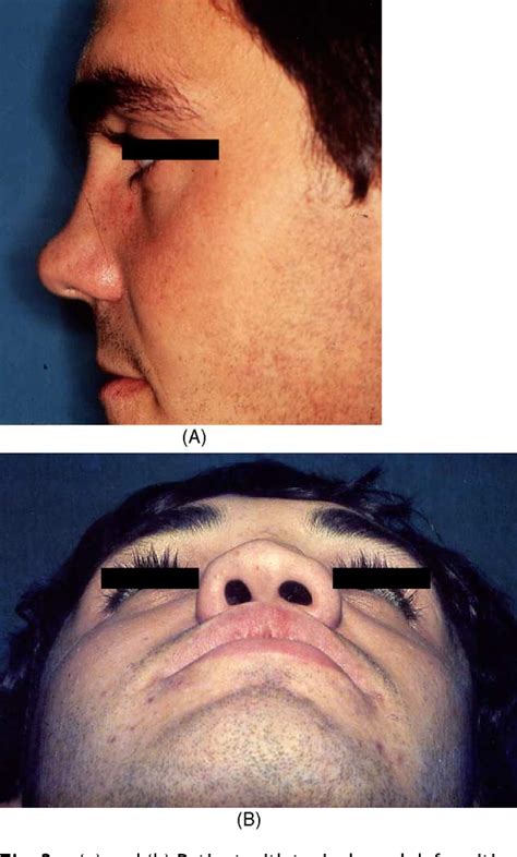 Pdf Management Of Nasal Septal Abscess In Childhood Our Experience