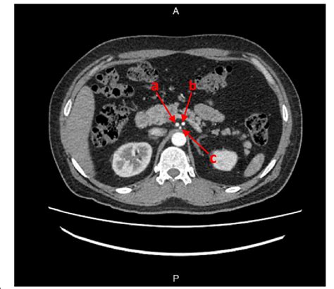 Abdominal Ct Scan Contrast In Arterial Phase Demonstrating The Common