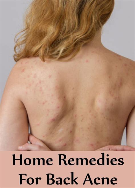 7 Home Remedies For Back Acne Natural Treatments And Cure For Back Acne