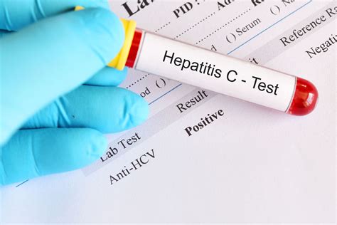 Diagnostic testing in hepatitis c virus infection. Everything You Need to Know About Hepatitis C - Midlands ...