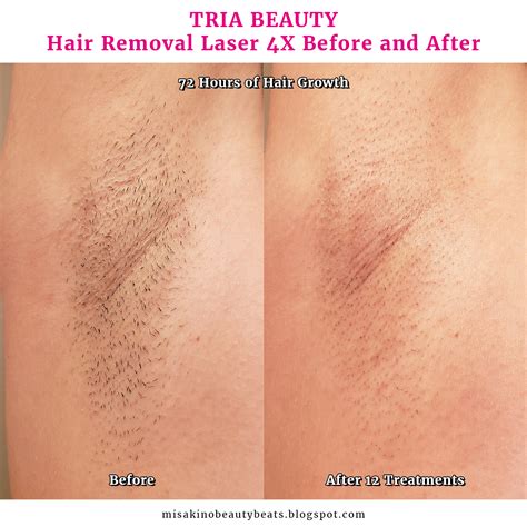 Review Tria Hair Removal Laser 4x Misakino