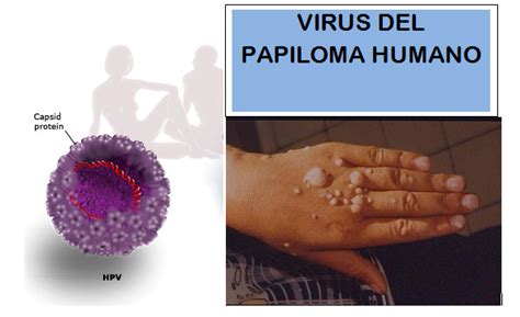 Virus Del Papiloma Humano Vph Microbiología General Uvg
