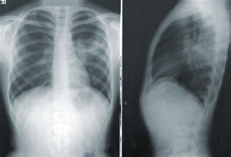 Pochp Przewlekła Obturacyjna Choroba Płuc Jakie Są Objawy I Możliwości Leczenia Bez