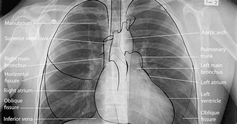 We've labeled and outlined the main visible anatomical structures such as lungs. What To Do When The Nurse Calls YOU !: How to Read Chest X ...