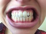 Images of Does Coconut Oil Whiten Teeth