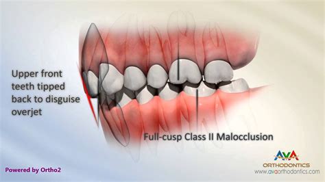 The first of the 'hallmark hall of fame' movies to air in hd widescreen. Tipped Back Front Teeth - Class II Div 2 Malocclusion ...