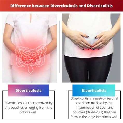 Diverticulosis Vs Diverticulitis Difference And Comparison