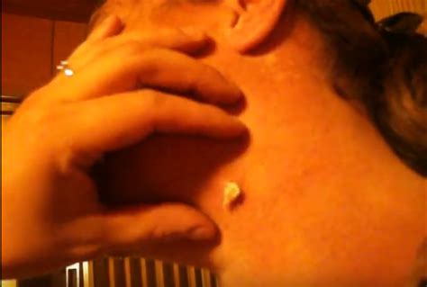 Me popping a previously surgically excised ganglion. Popping Husbands Cyst On His Neck | Viral On The Web Now