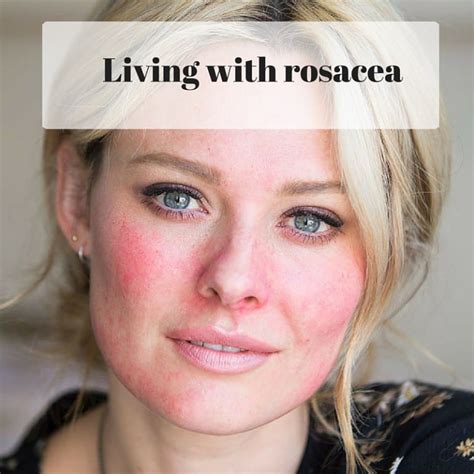 Living With Rosacea And Searching For Solutions To Redness