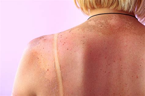 Sunspots On Skin Causes Types And Treatment Options Better Off
