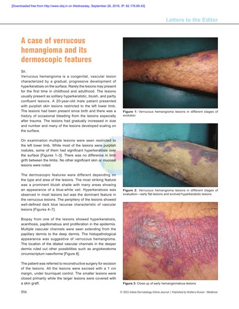 Pdf A Case Of Verrucous Hemangioma And Its Dermoscopic Features