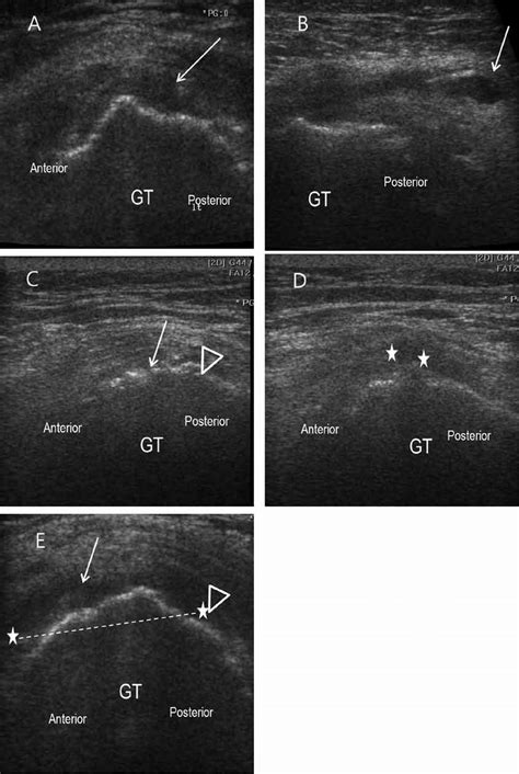 Ultrasound Finding In Greater Trochanter Pain Syndrome A Gluteus