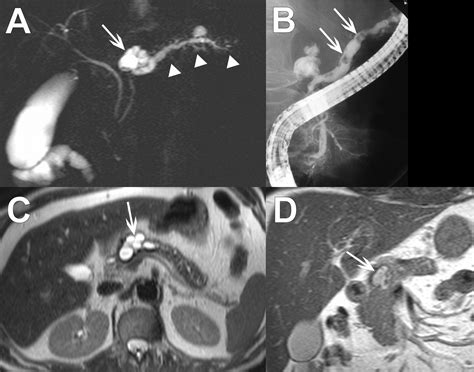 Mr Imaging Of The Pancreas A Pictorial Tour Radiographics