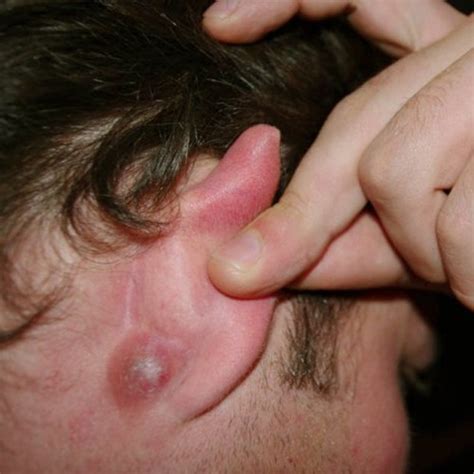 Pimple In Ear Causes Treatment Pictures