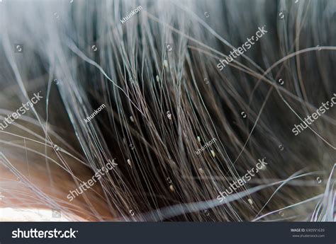 Lice Eggs On Childs Head Cause Stock Photo 690991639 Shutterstock