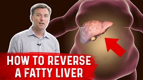 how to reverse a fatty liver youtube