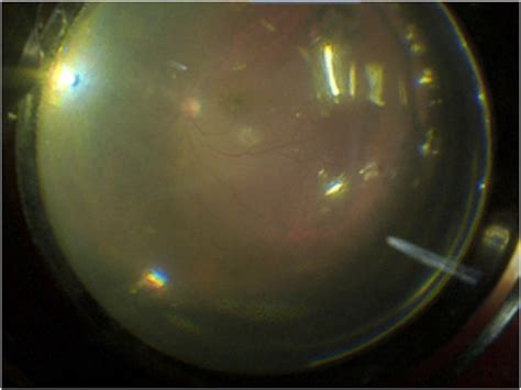 Retinal Reattachment Under Air Fill The Retina Is Reattached Under