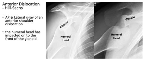 Fig 13 Traumatic Anterior Dislocation X Ray Of An Anterior