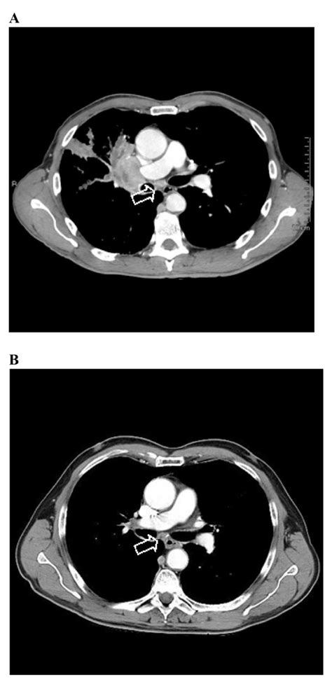Chest Computed Tomography Scan A Before Treatment Of Docetaxel B 10
