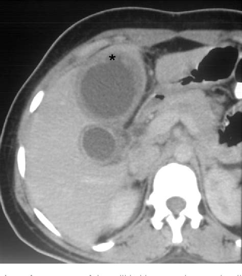 Figure 3 From The Ct Appearances Of Gallbladder Perforation Semantic