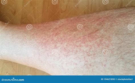 Itchy Raised Skin Bumps On Legs